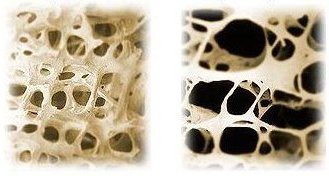 Osteoporose Durch Milch